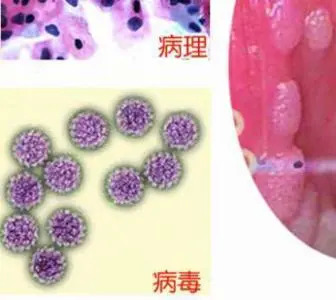 男性尖锐湿疣初期症状和治疗方法
