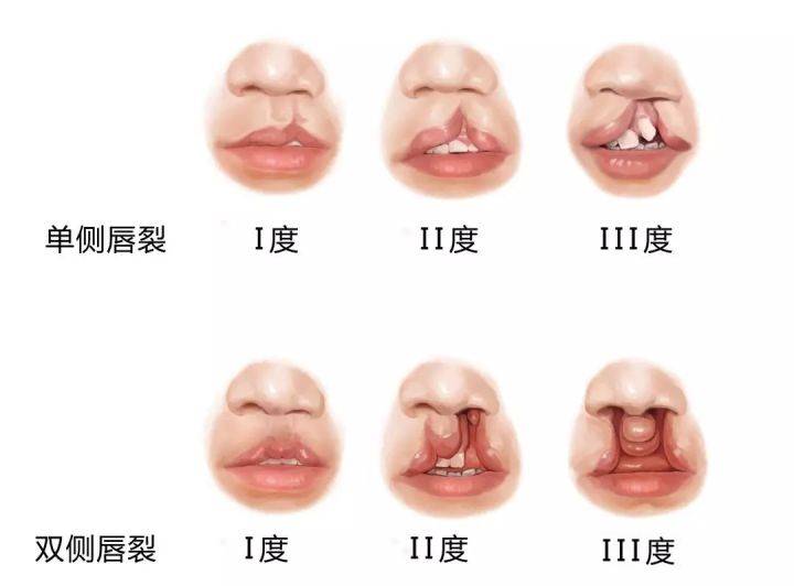 唇腭裂图片 唇腭裂患者如何进行修复？